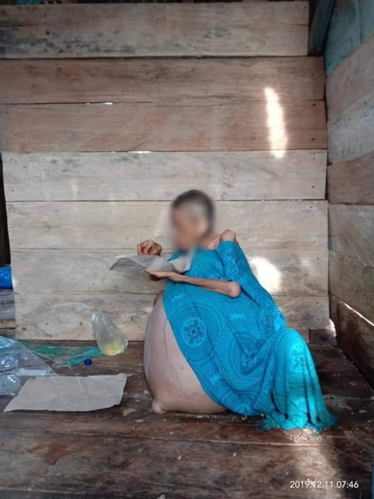 DIDUGA TUMOR PERUT, WANITA DI BUTUR INI BUTUH ULURAN TANGAN PARA DERMAWAN